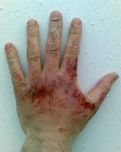 Caustic soda chemical burn on hand